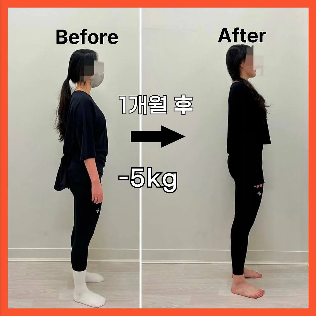 체형 교정 전후